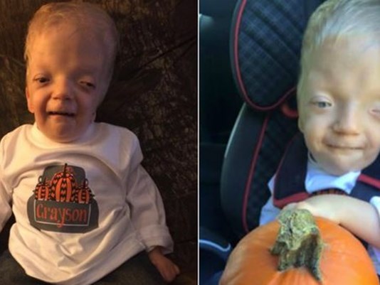 Toddler bullied by cruel trolls over rare skin condition which 'makes him  look yellow' - Mirror Online